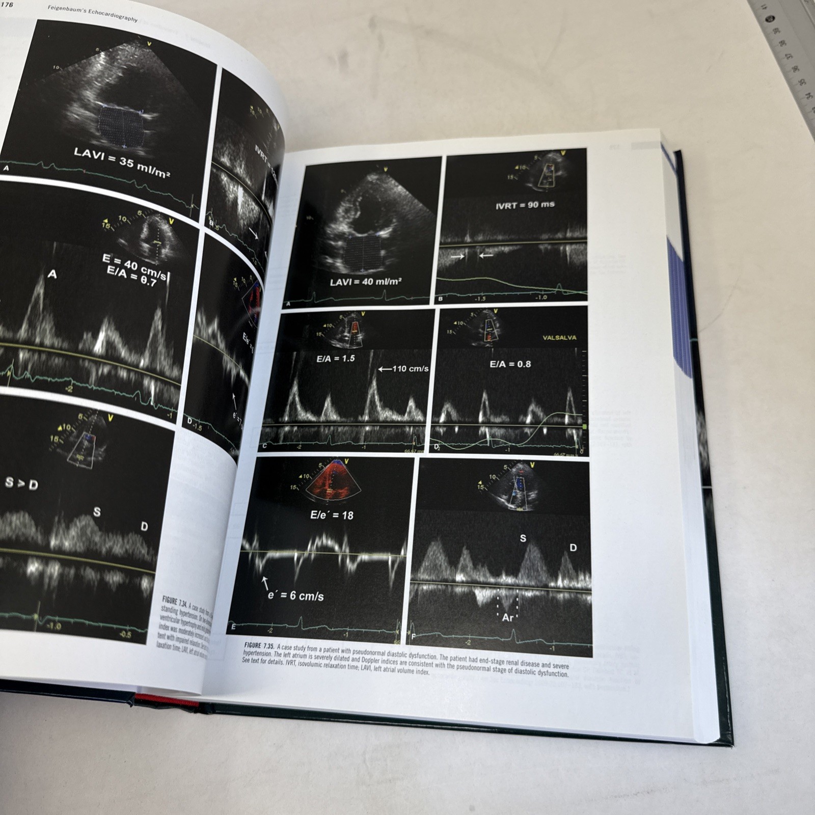 Feigenbaum&rsquo;s Echocardiography by Thomas Ryan and William F. Armstrong (2009,…