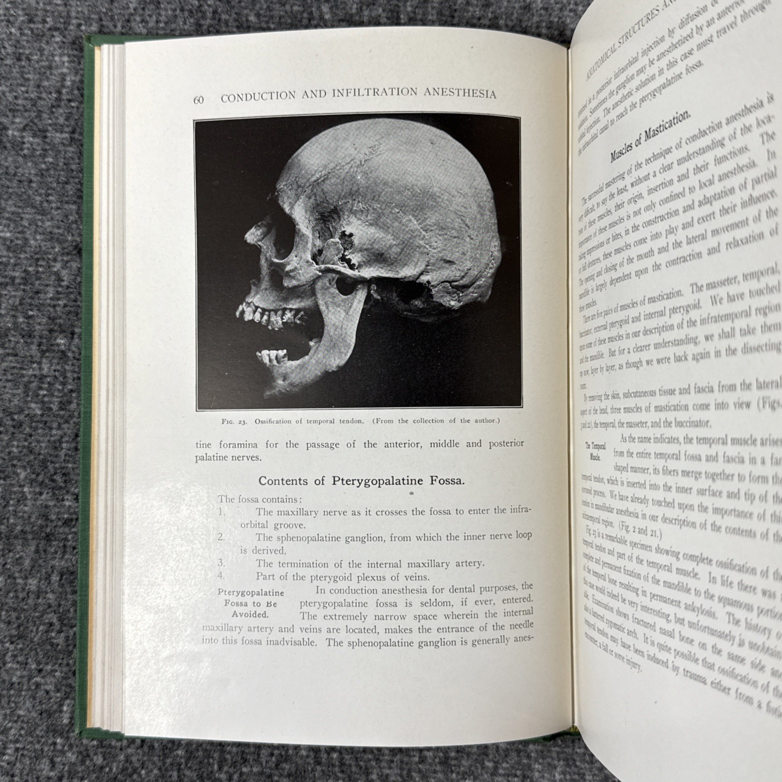 Conduction Infiltration General Anesthesia Dentistry 1943 4th Nevin & Puterbaugh